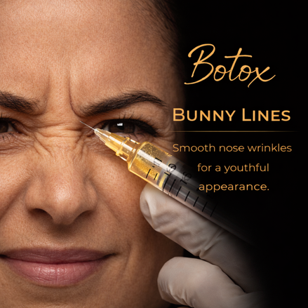 Botox for Bunny Lines  10 units - Softens nose wrinkles that appear when smiling or scrunching. Typical starting dose: 4–8 units.